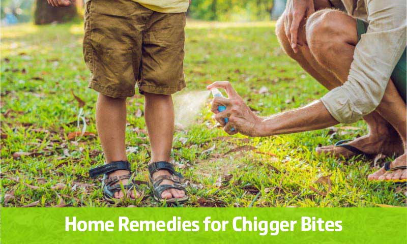 Home Remedies for Chigger Bites