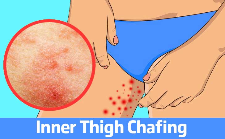 Inner Thigh Chafing