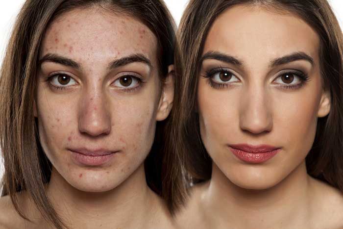 Acne Face Treatment